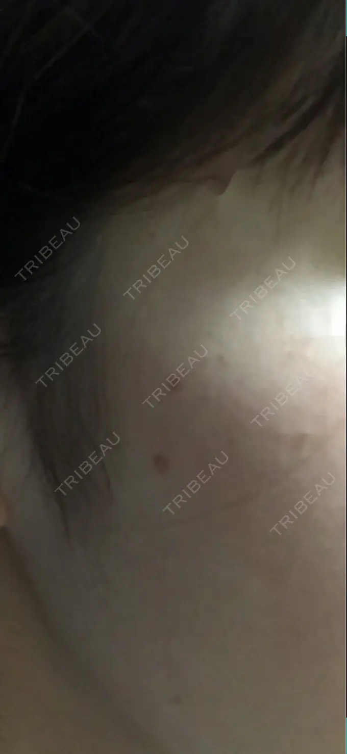 ほくろ・いぼ切除（肌） シンシアガーデンクリニック 太田院 DAY 21 メイン用