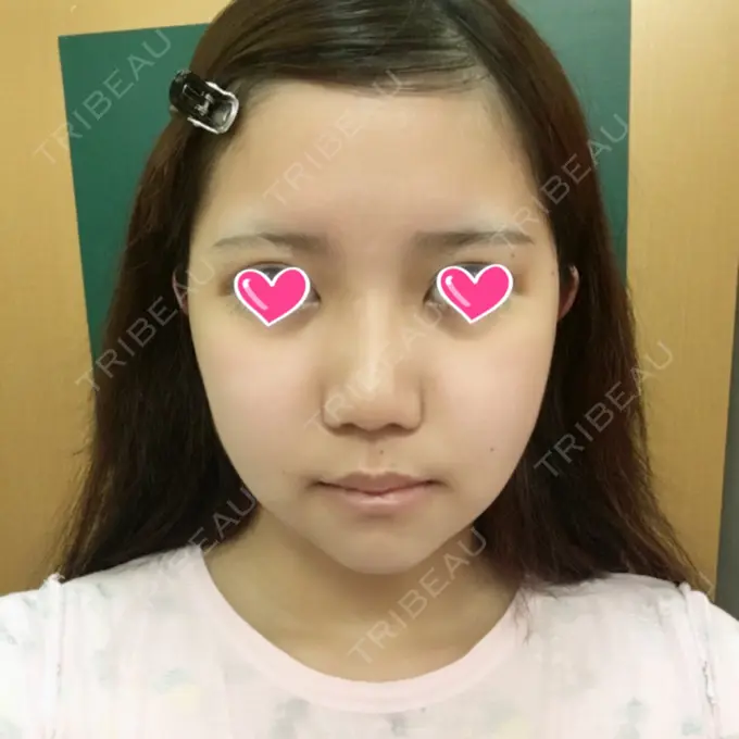 骨切り（あご） / 骨削り（エラ） / 骨削り（頬） View美容整形外科 DAY 9 メイン用