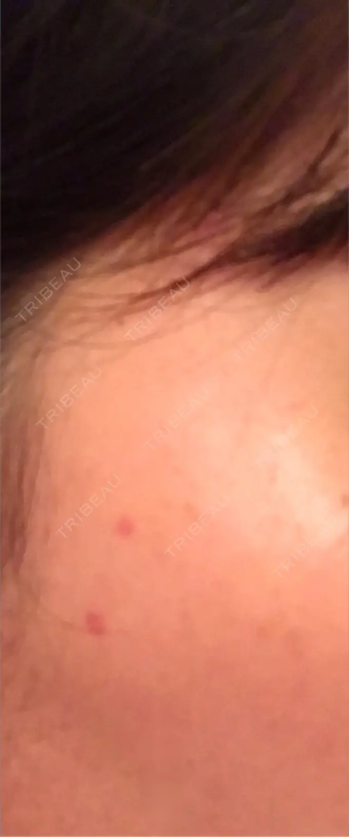 ほくろ・いぼ切除（肌） シンシアガーデンクリニック 太田院 DAY 22 メイン用