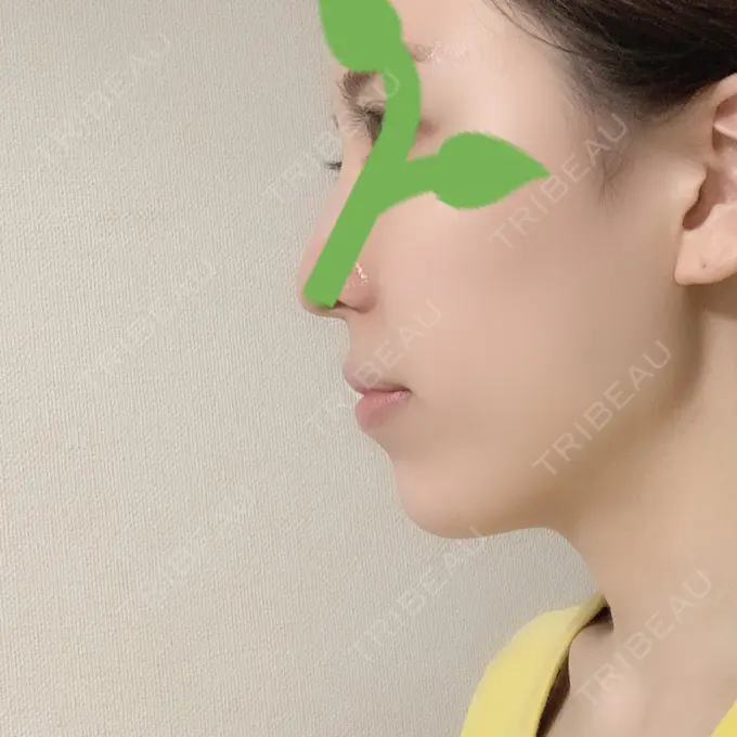 ボトックス（あご） / ヒアルロン酸注入（あご） / ボトックス（エラ・小顔） TCB東京中央美容外科 新宿東口院 DAY 28 メイン用