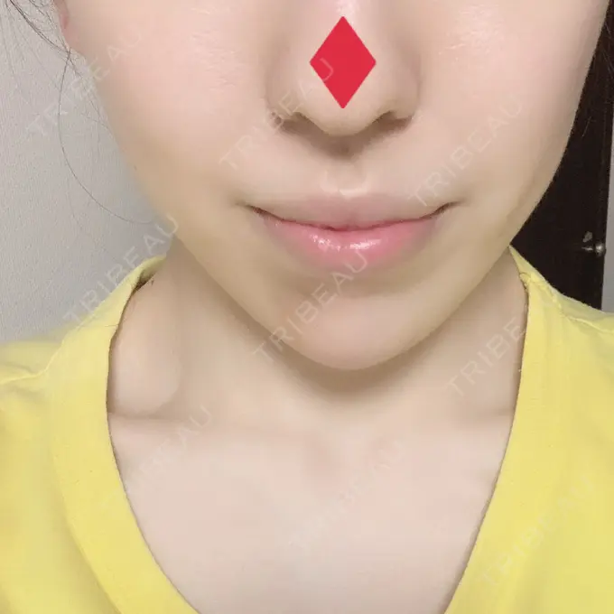 ボトックス（あご） / ヒアルロン酸注入（あご） / ボトックス（エラ・小顔） TCB東京中央美容外科 新宿東口院 DAY 28 メイン用