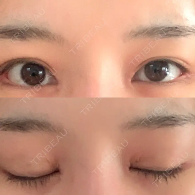 目頭切開 / 目尻切開 新宿ラクル美容外科クリニック 新宿院 DAY 26 メイン用