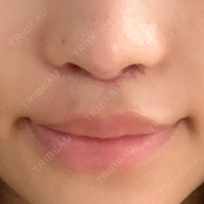 人中短縮 新宿ラクル美容外科クリニック 新宿院 DAY 26 メイン用