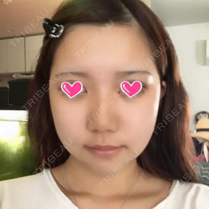 骨切り（あご） / 骨削り（エラ） / 骨削り（頬） View美容整形外科 DAY 10 メイン用