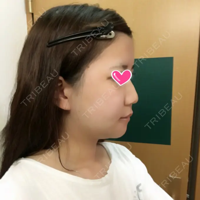 骨切り（あご） / 骨削り（エラ） / 骨削り（頬） View美容整形外科 DAY 10 メイン用