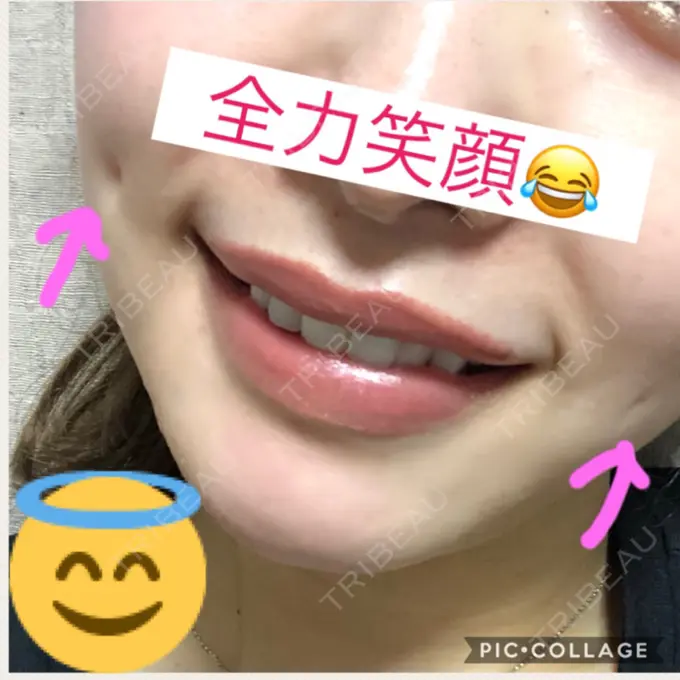 その他（輪郭） / その他（口元） / その他 ドクターゴールドマンクリニック 東京高輪院 DAY 84 メイン用