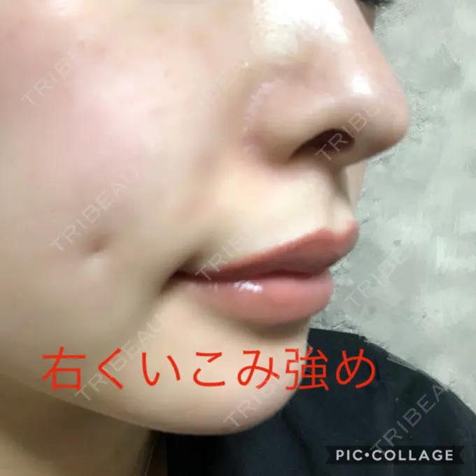 その他（輪郭） / その他（口元） / その他 ドクターゴールドマンクリニック 東京高輪院 DAY 84 メイン用