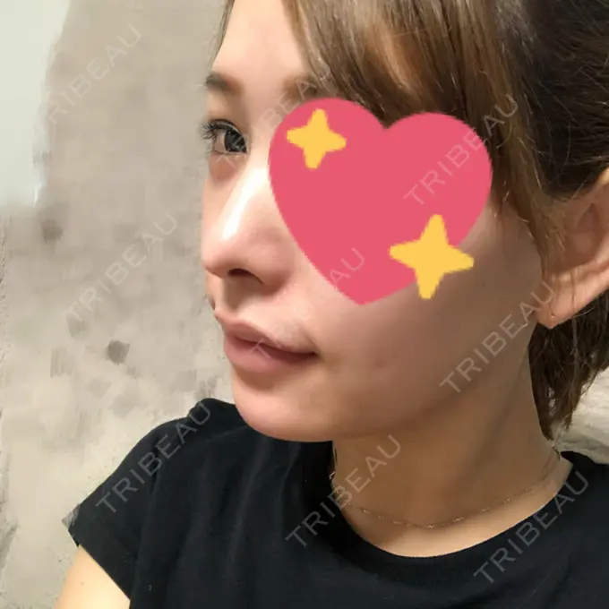 あごプロテーゼ / 輪郭修正 高崎TAクリニック AFTER メイン用