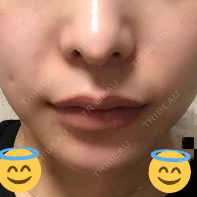 あごプロテーゼ / 輪郭修正 高崎TAクリニック DAY 133 メイン用