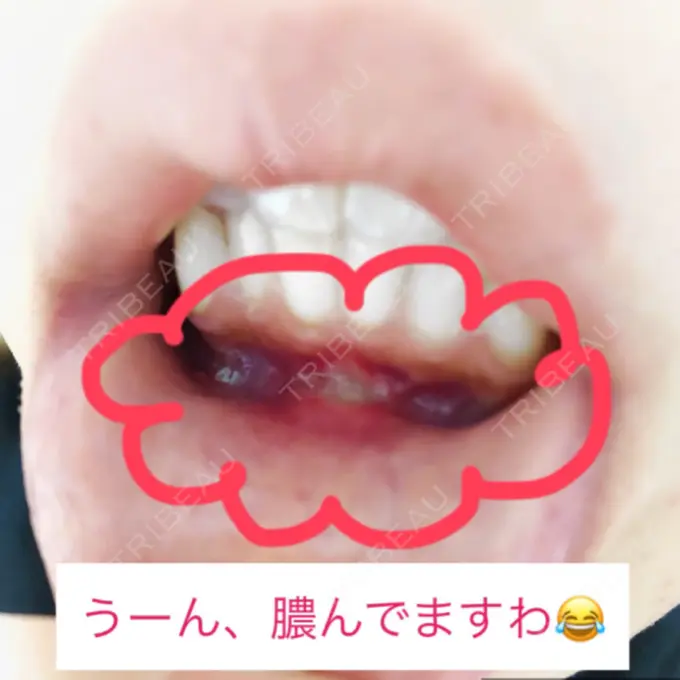 あごプロテーゼ / 輪郭修正 高崎TAクリニック DAY 133 メイン用