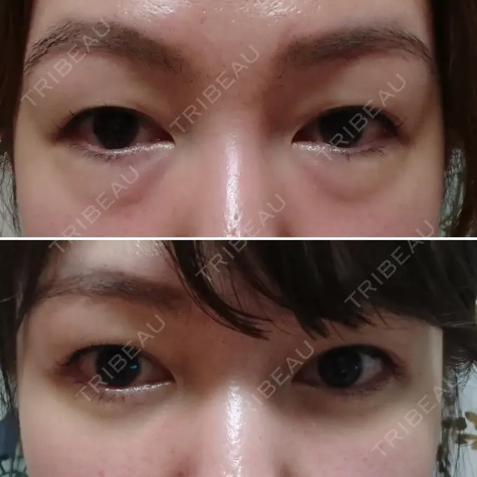 クマ治療 / 下まぶたたるみ取り / 下まぶたの脂肪取り / 脂肪注入（肌） コスメディカルクリニック シンシア 銀座院 DAY 20 メイン用