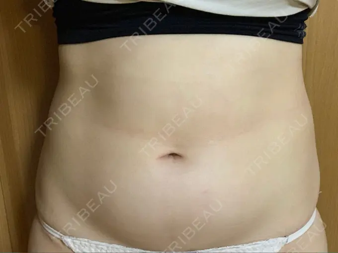 脂肪冷却（輪郭） 湘南美容クリニック 名古屋栄院 DAY 1 メイン用