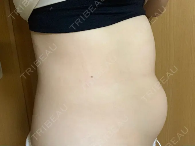 脂肪冷却（輪郭） 湘南美容クリニック 名古屋栄院 DAY 1 メイン用