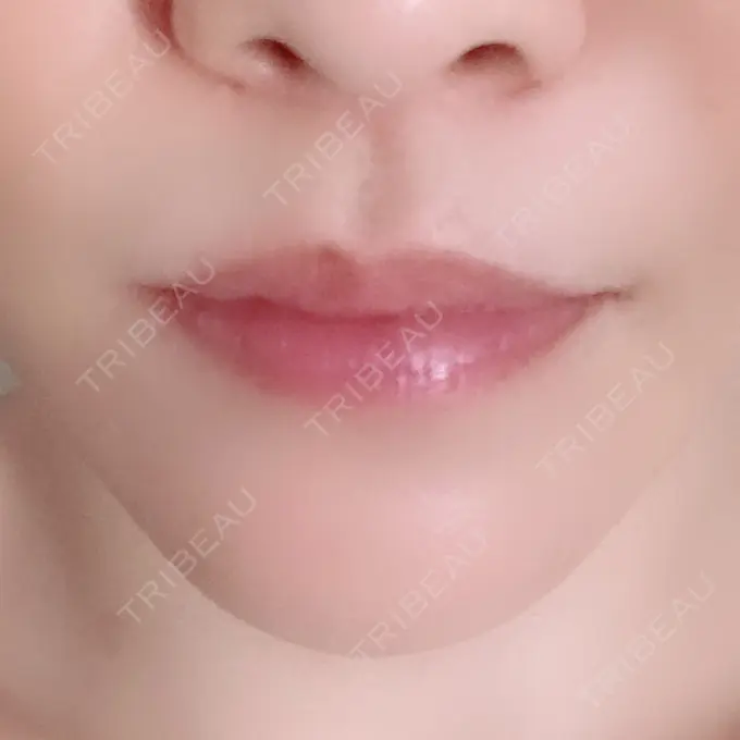 人中短縮 ドクターゴールドマンクリニック 大阪院 DAY 150 メイン用