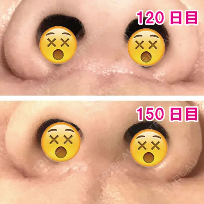 人中短縮 ドクターゴールドマンクリニック 大阪院 DAY 150 メイン用