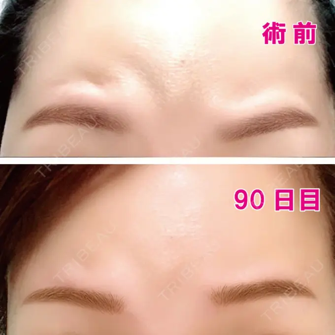 眉下切開 エイペックス美容外科 DAY 90 メイン用