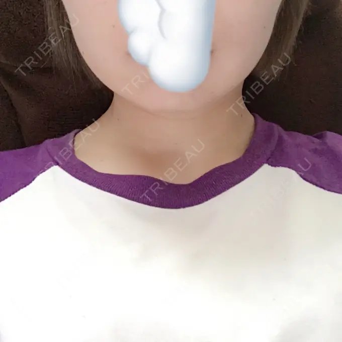 脂肪溶解注射（顔） 湘南美容クリニック 長野院 DAY 1 メイン用