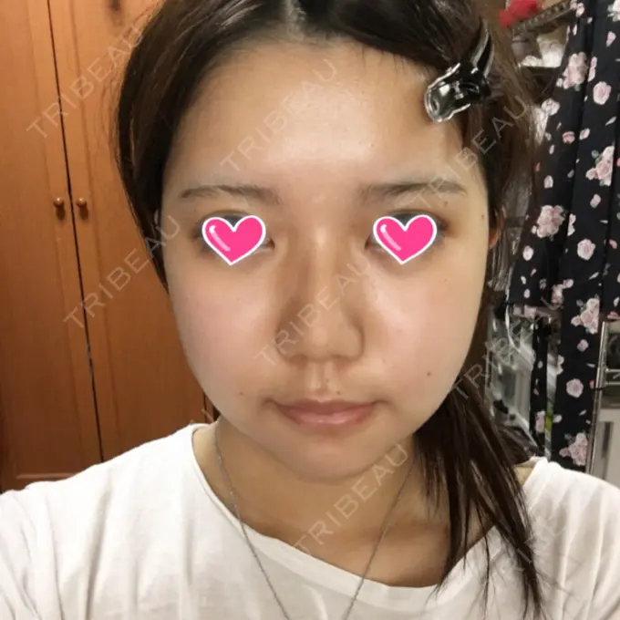 骨切り（あご） / 骨削り（エラ） / 骨削り（頬） View美容整形外科 DAY 11 メイン用