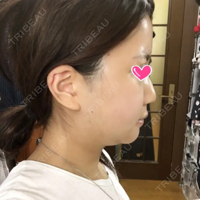 骨切り（あご） / 骨削り（エラ） / 骨削り（頬） View美容整形外科 DAY 11 メイン用