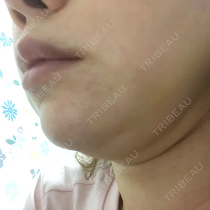 二重埋没 / 糸リフト / 脂肪吸引（顔） / ボトックス（あご） / ヒアルロン酸注入（あご） TCB東京中央美容外科 新宿東口院 DAY 7 メイン用