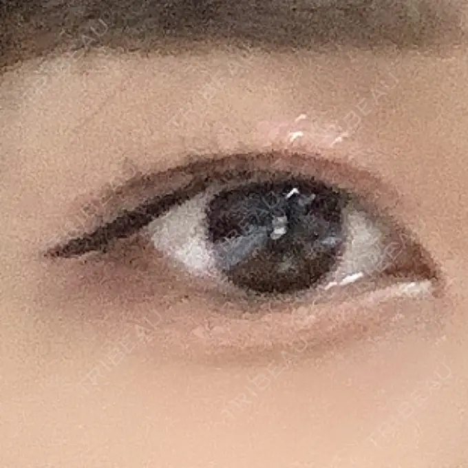 二重切開 よこはまエーブクリニック AFTER メイン用