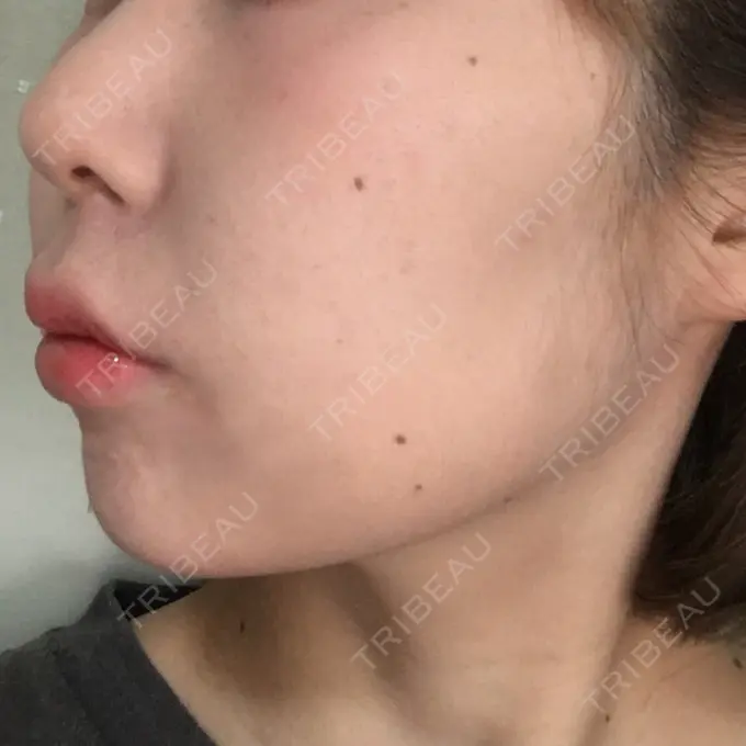 脂肪溶解注射（顔） 湘南美容クリニック 長野院 DAY 2 メイン用