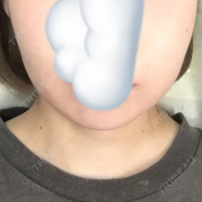 脂肪溶解注射（顔） 湘南美容クリニック 長野院 DAY 2 メイン用