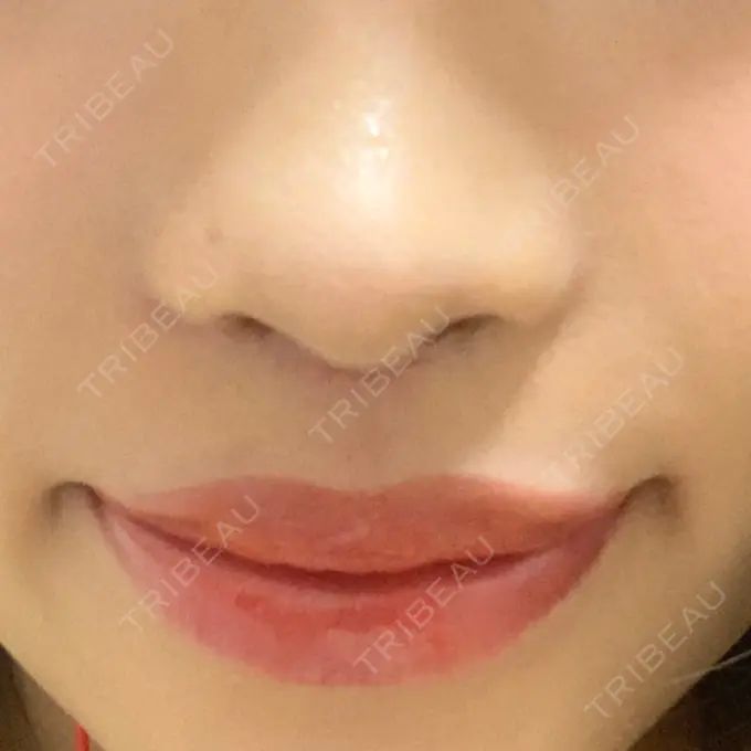 人中短縮 新宿ラクル美容外科クリニック 新宿院 DAY 28 メイン用