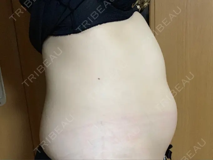 脂肪冷却（輪郭） 湘南美容クリニック 名古屋栄院 DAY 3 メイン用