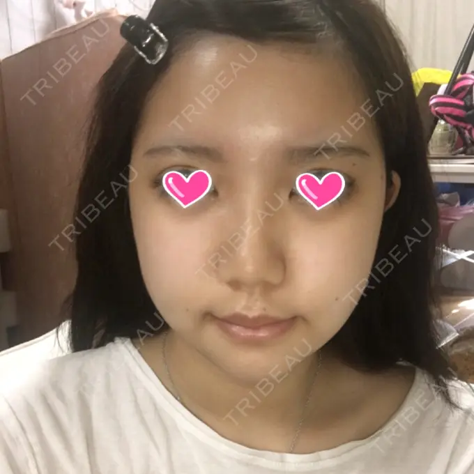 骨切り（あご） / 骨削り（エラ） / 骨削り（頬） View美容整形外科 DAY 12 メイン用