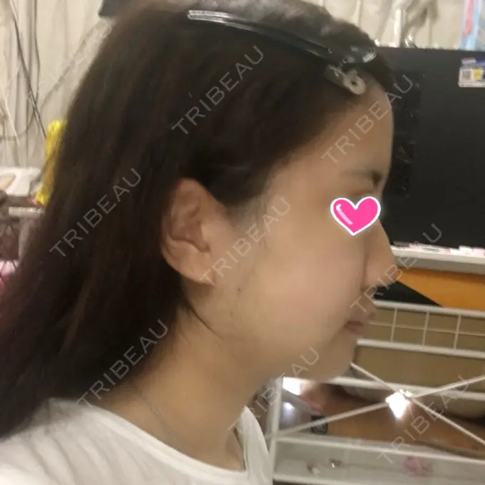 骨切り（あご） / 骨削り（エラ） / 骨削り（頬） View美容整形外科 DAY 12 メイン用