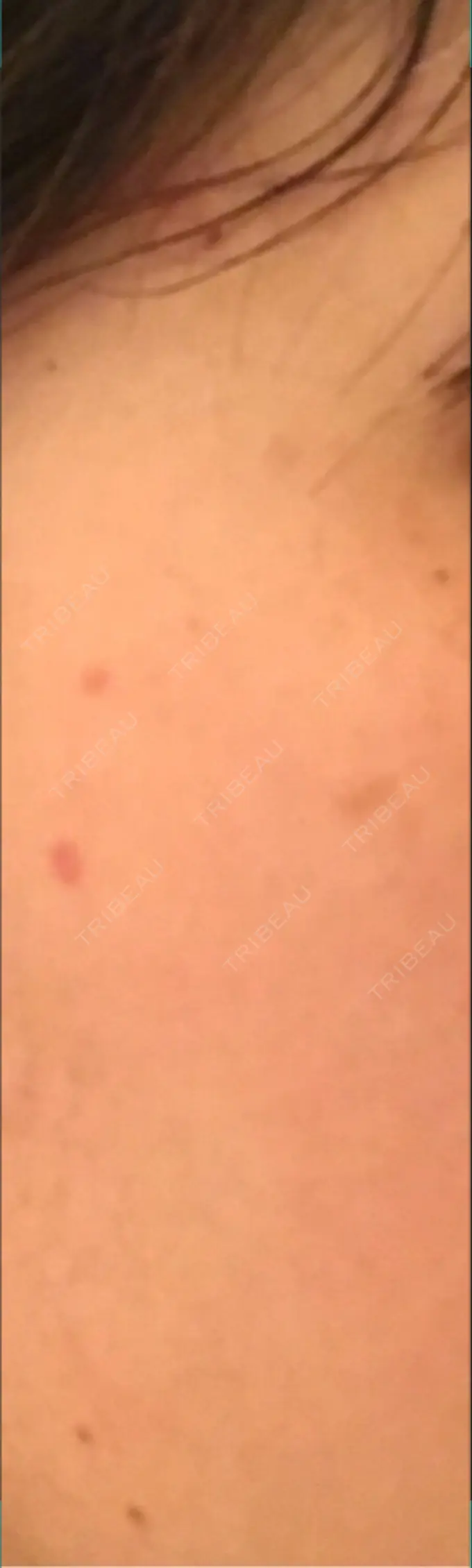 ほくろ・いぼ切除（肌） シンシアガーデンクリニック 太田院 DAY 25 メイン用