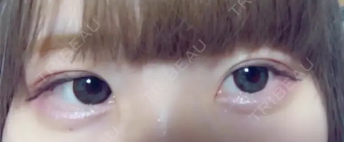 二重埋没 湘南美容クリニック 長野院 DAY 10 メイン用