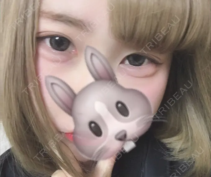 二重埋没 湘南美容クリニック 長野院 DAY 30 メイン用