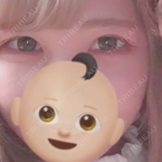 二重埋没 湘南美容クリニック 長野院 DAY 30 メイン用