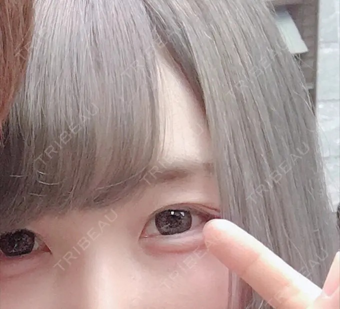 二重埋没 湘南美容クリニック 長野院 DAY 30 メイン用