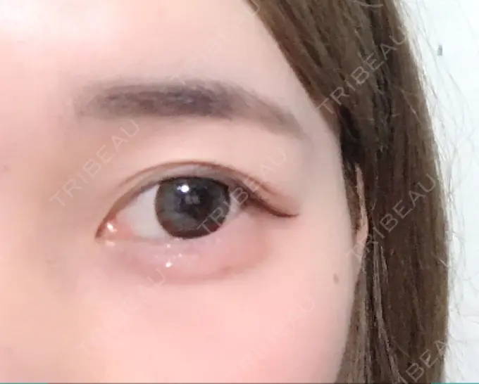 二重埋没 湘南美容クリニック 長野院 DAY 57 メイン用