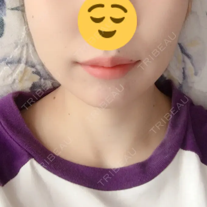 脂肪溶解注射（顔） 湘南美容クリニック 長野院 DAY 3 メイン用