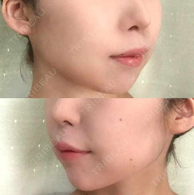 脂肪溶解注射（顔） 湘南美容クリニック 長野院 DAY 3 メイン用