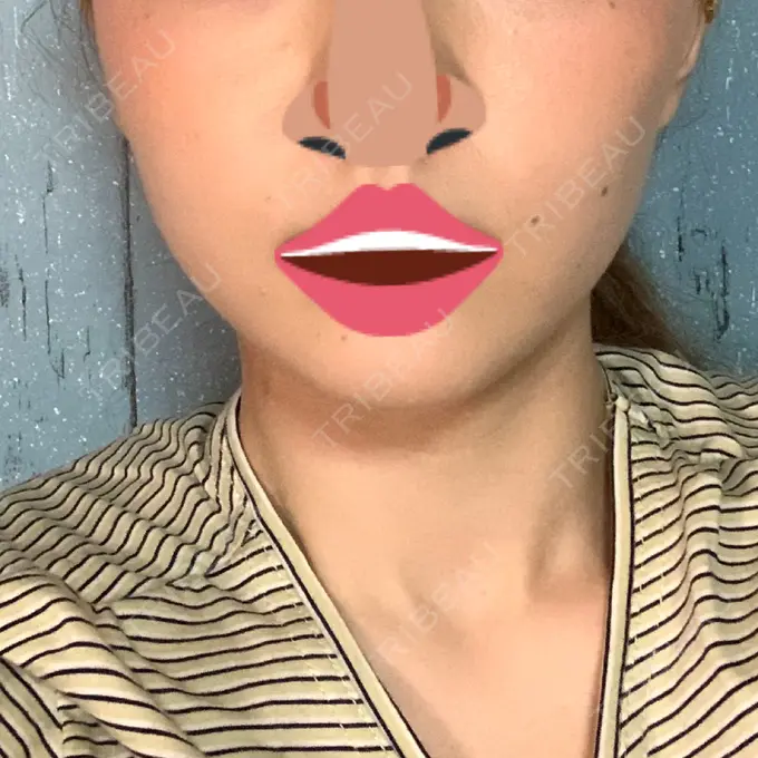 ボトックス（エラ・小顔） 品川スキンクリニック心斎橋院 DAY 30 メイン用