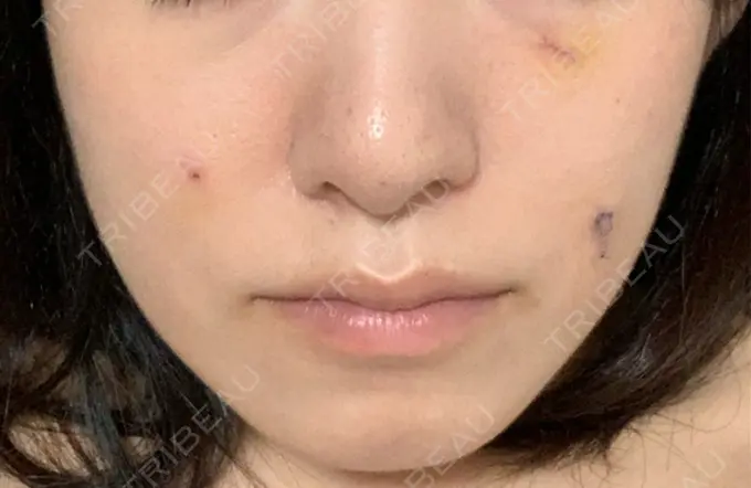 ボトックス（エラ・小顔） TCB東京中央美容外科 郡山院 DAY 105 メイン用