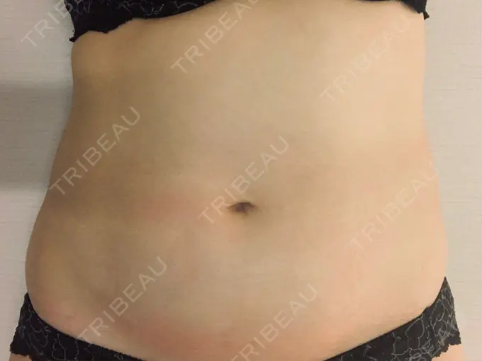 脂肪冷却（輪郭） 湘南美容クリニック 名古屋栄院 AFTER メイン用