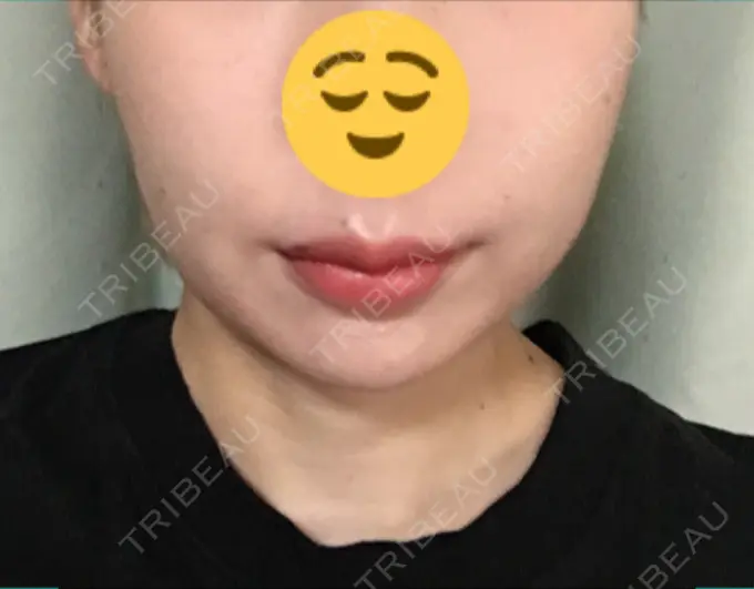 脂肪溶解注射（顔） 湘南美容クリニック 長野院 DAY 4 メイン用