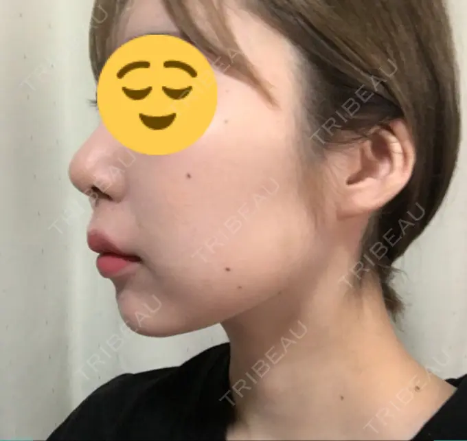 脂肪溶解注射（顔） 湘南美容クリニック 長野院 AFTER メイン用