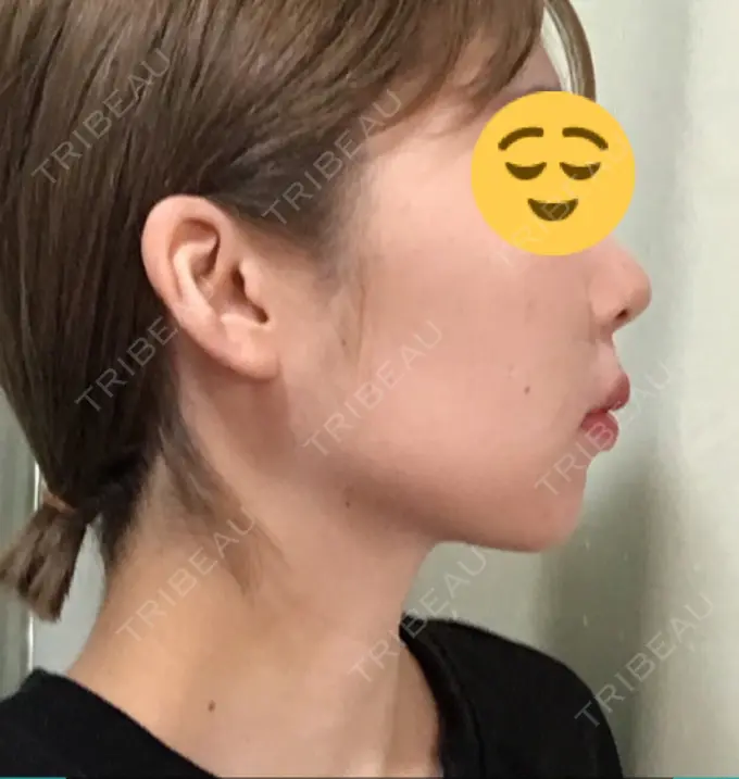 脂肪溶解注射（顔） 湘南美容クリニック 長野院 DAY 4 メイン用