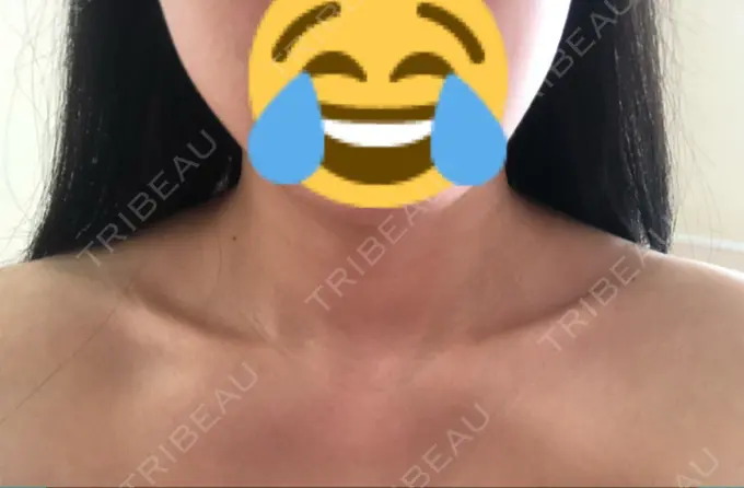 ボトックス（肩） 洗足整形・形成外科 DAY 2 メイン用