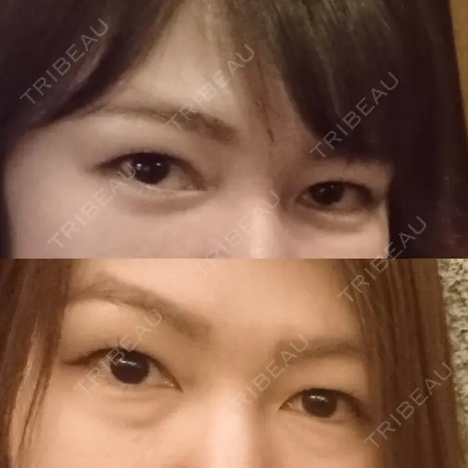 クマ治療 / 下まぶたたるみ取り / 下まぶたの脂肪取り / 脂肪注入（肌） コスメディカルクリニック シンシア 銀座院 DAY 24 メイン用