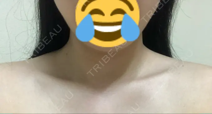 ボトックス（肩） 洗足整形・形成外科 DAY 3 メイン用