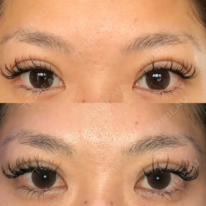 二重埋没 湘南美容クリニック 京都院 DAY 22 メイン用