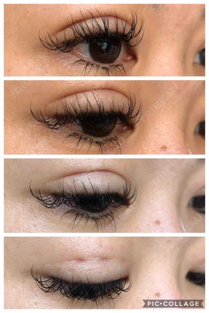 二重埋没 湘南美容クリニック 京都院 DAY 31 メイン用